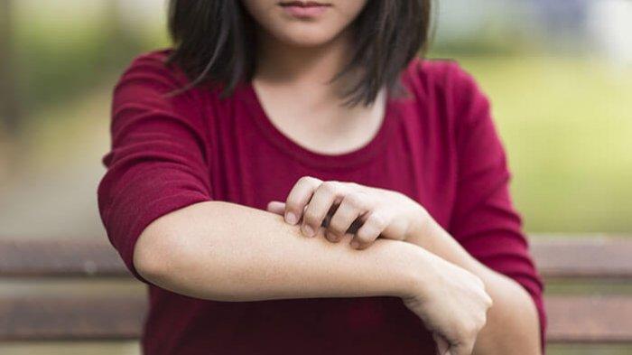 Dermatitis herpetiformis adalah kondisi yang memiliki gejala seperti merasa gatal
