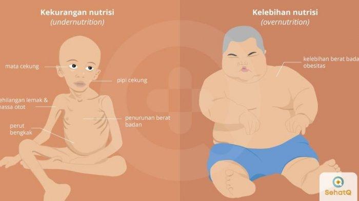 ilustrasi malnutrisi