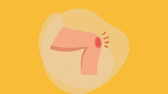 Penyakit Osgood-Schlatter 3