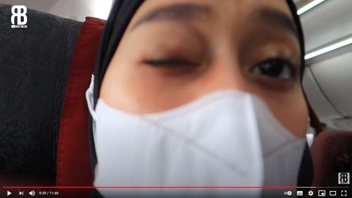 Penampakan lebam di mata Lesti Kejora karena Rizky Billar.