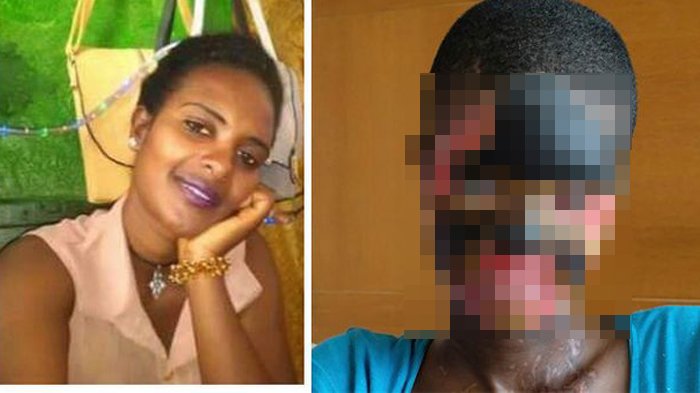 Wanita yang disiram air keras